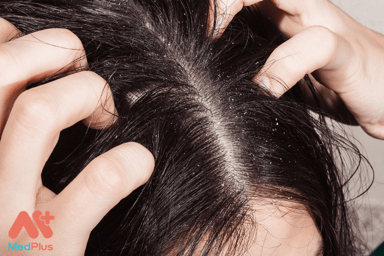 Tinh dầu gỗ tuyết tùng phù hợp để điều trị các bệnh về da đầu