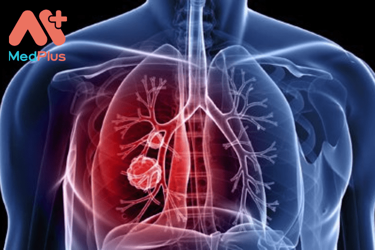 Tăng áp động mạch phổi TOP 8 bài viết hay 2023