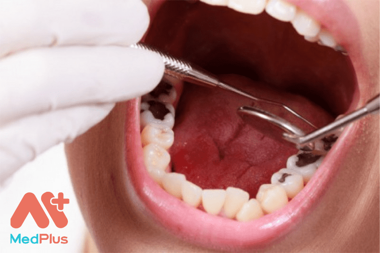 [TOP 5] bài viết về Thuốc trị sâu răng hữu ích 2023