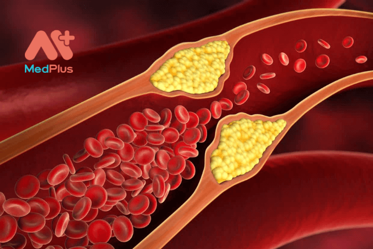 Tổng quan về Cholesterol (mỡ trong máu)