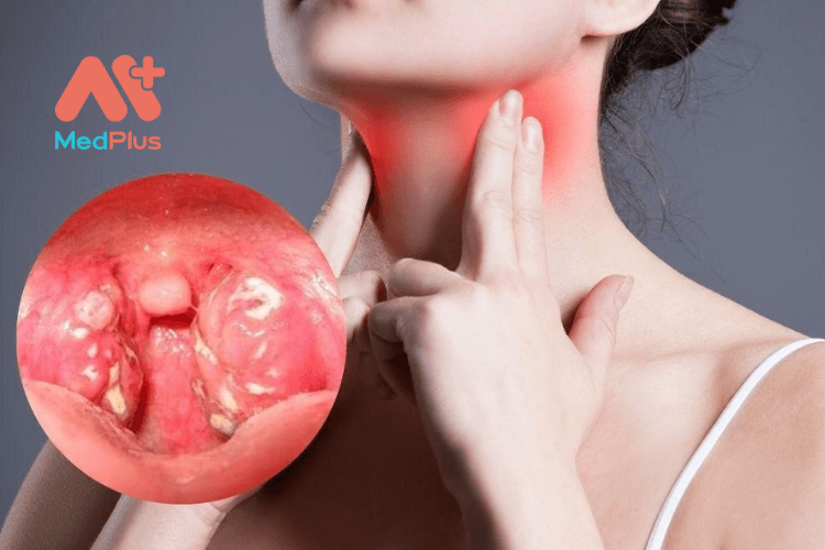 Viêm amiđan gây đau cổ họng, ảnh hưởng đến sức khỏe và cuộc sống