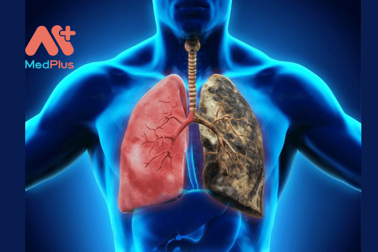 Bệnh phổi: nguyên nhân và cách điều trị