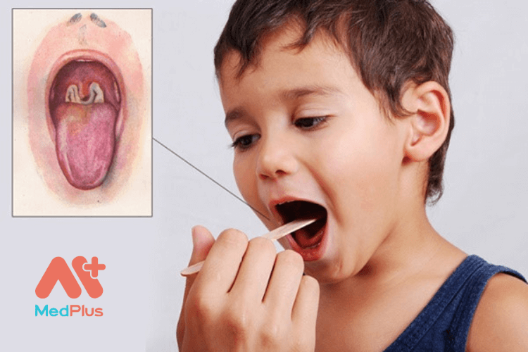 Bạch hầu là một bệnh nhiễm trùng nghiêm trọng do vi khuẩn chủ yếu ảnh hưởng đến cổ họng và mũi