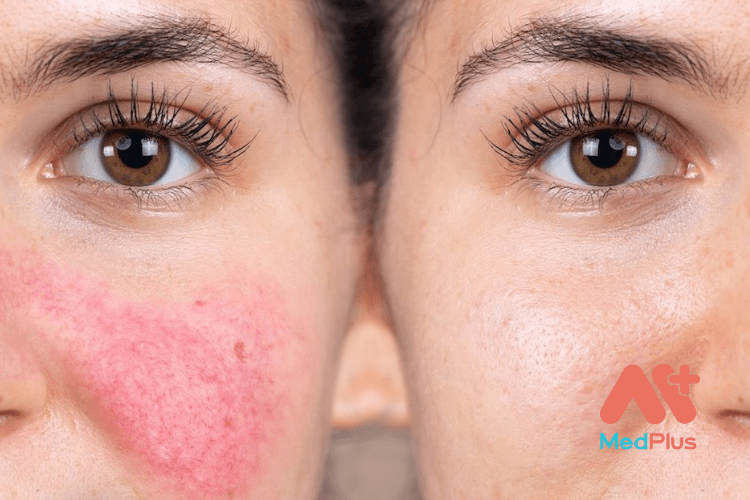 Bệnh đỏ mặt gây mẩn đỏ, viêm và đôi khi là mụn nhỏ hoặc mụn mủ trên mặt