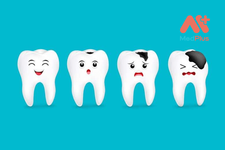 sâu răng gây mất thẩm mỹ, ảnh hưởng đến sức khỏe và cuộc sống người bệnh